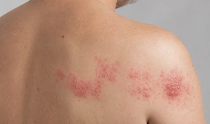 El herpes zóster, un factor de riesgo cardiovascular no tan conocido